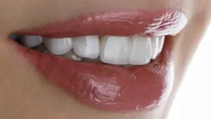 En İyi Diş Kaplama