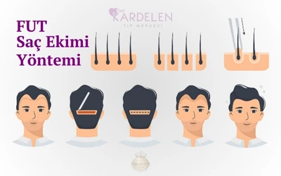 FUT Saç Ekimi Yöntemi İllüstrasyonu