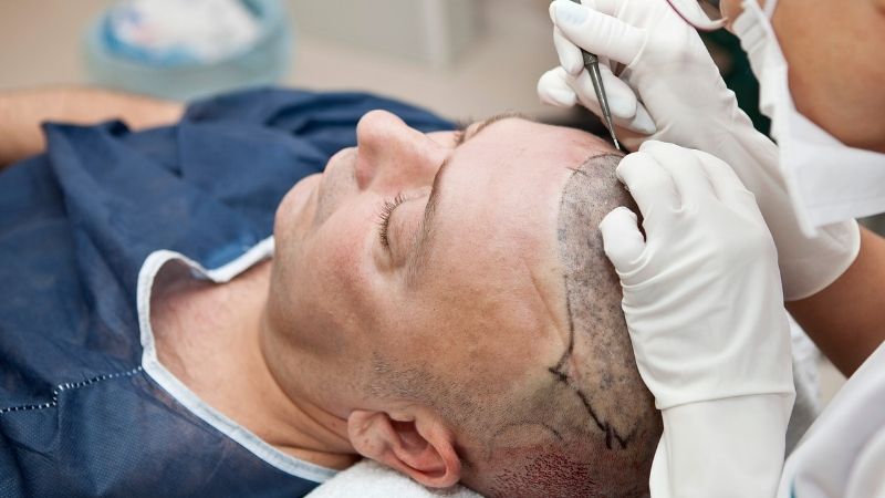 dhi hair transplant during