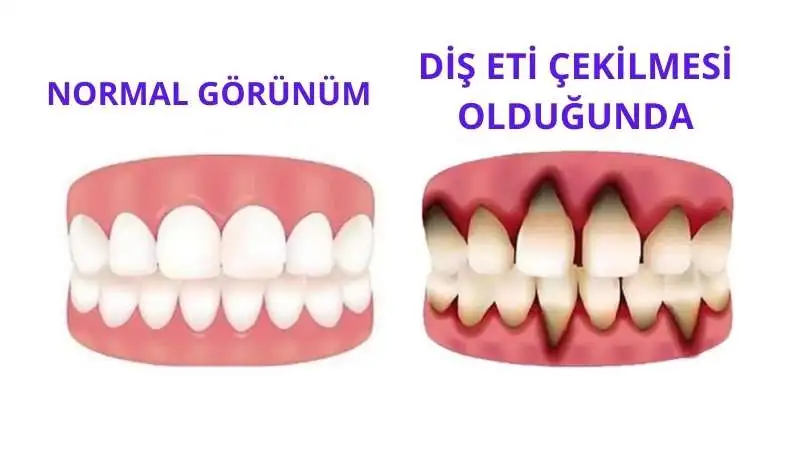 Diş Eti Çekilmesi Neden olur?