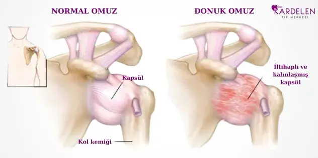 Donuk Omuz Belirtileri ve Tedavisi 1 Donuk Omuz