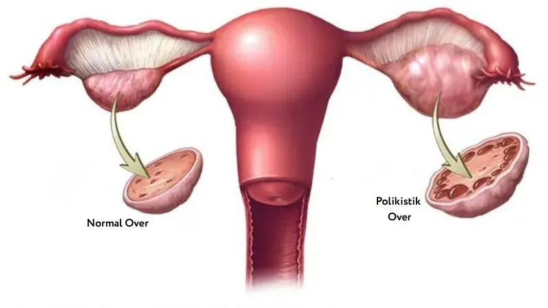 Polikistik Over Sendromu (PCOS) Nedir? Belirtileri ve Tedavisi 1 Polikistik Over Sendromu (PCOS) Nedir?