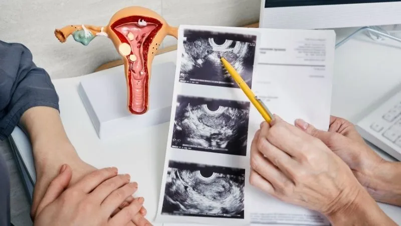 Polikistik over sendromu (PCOS)