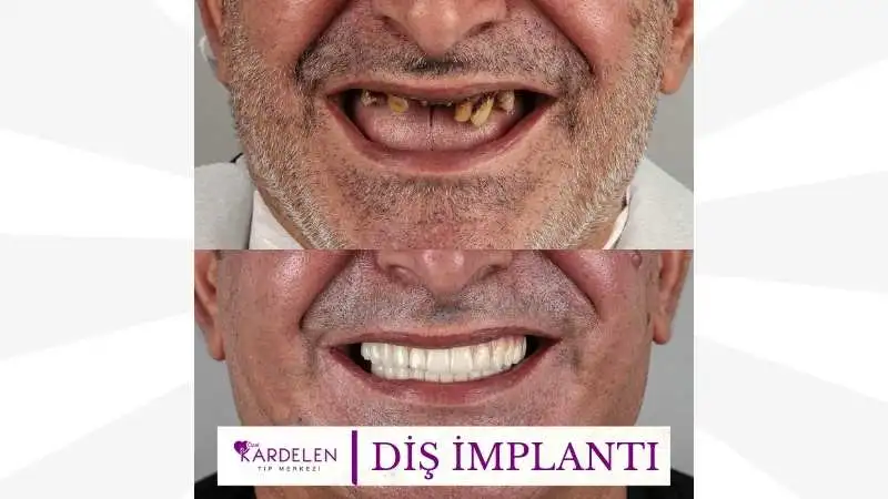 Diş İmplantı Nedir? Kimlere Uygulanır? 1 Diş İmplantı 2