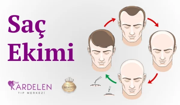 Saç Ekimi