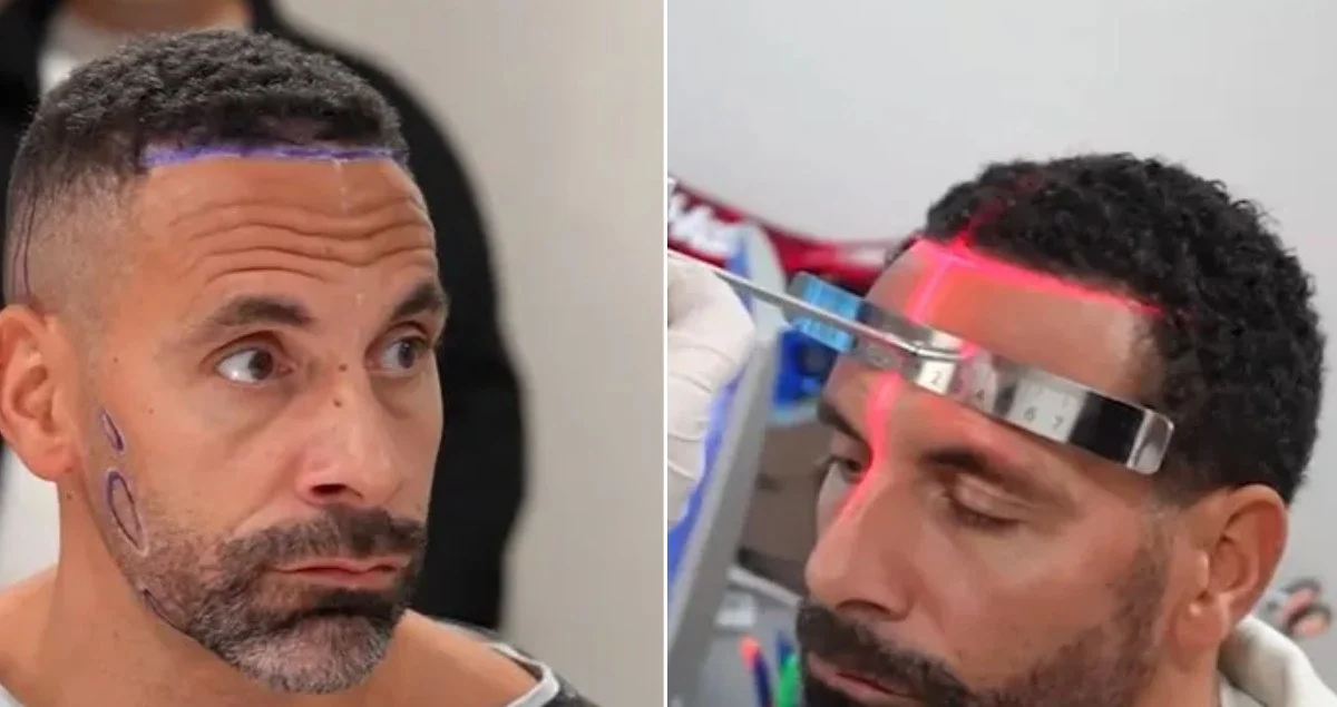 Rio Ferdinand Saç Ekimi Yaptırdı mı?